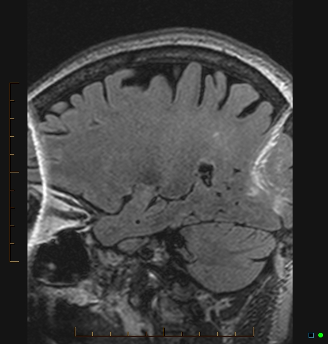 Aliasing artifact causing a spurious cerebellar lesion (Radiopaedia 48783-53810 Sagittal FLAIR 83).jpg
