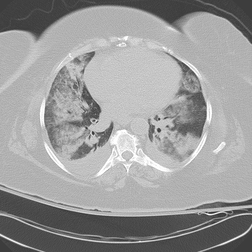 All trans retinoic acid (ATRA) syndrome (Radiopaedia 38212-40229 Axial lung window 34).jpg