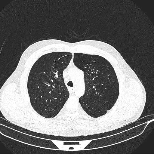 File:Allergic bronchopulmonary aspergillosis (Radiopaedia 21386-21320 Axial lung window 11).jpg