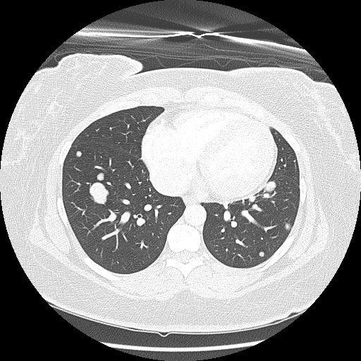 Alveolar soft part sarcoma - right leg (Radiopaedia 59432-67091 Axial lung window 76).jpg