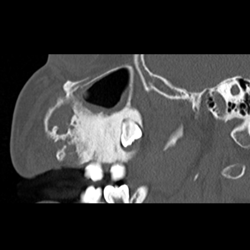 File:Ameloblastic fibro-odontoma (Radiopaedia 18843-18780 bone window 11).jpg