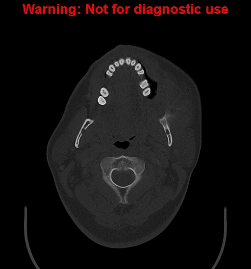 File:Ameloblastoma (Radiopaedia 33126-34164 Axial bone window 9).jpg