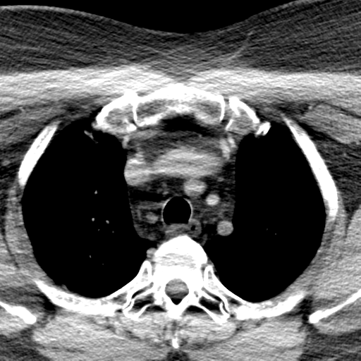 Ameloblastoma (Radiopaedia 38520-40623 Axial non-contrast 84).png