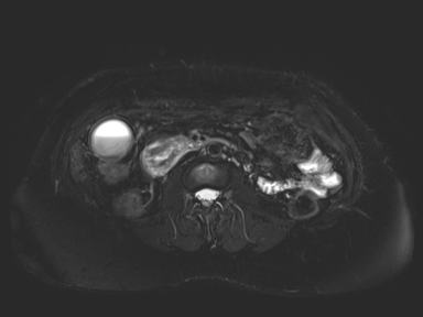 Ampullary adenocarcinoma (Radiopaedia 54765-61014 Axial T2 space-FS 47).jpg