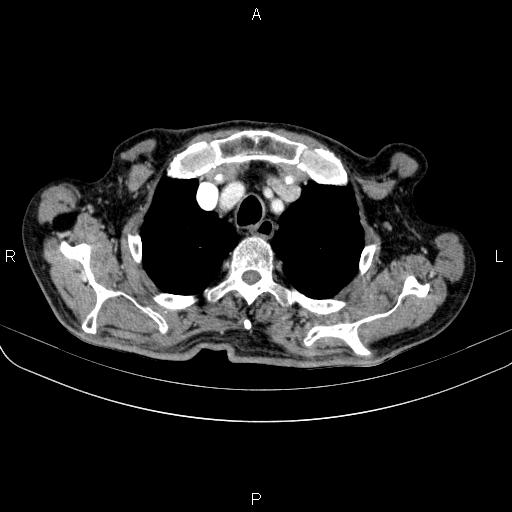 Ampullary adenocarcinoma (Radiopaedia 86093-102033 B 18).jpg