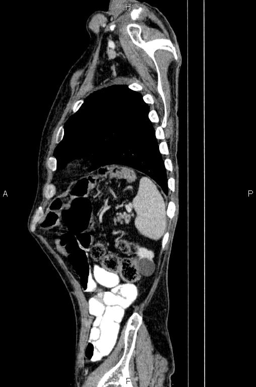 Ampullary adenocarcinoma (Radiopaedia 86093-102033 E 78).jpg