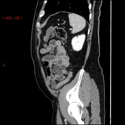 Ampullary carcinoma (Radiopaedia 56396-63056 D 87).jpg