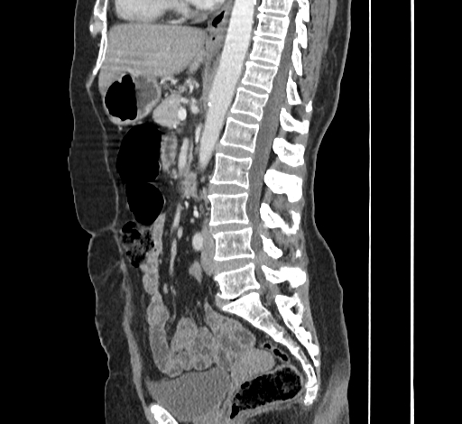 File:Ampullary tumor (Radiopaedia 60333-67998 C 30).jpg
