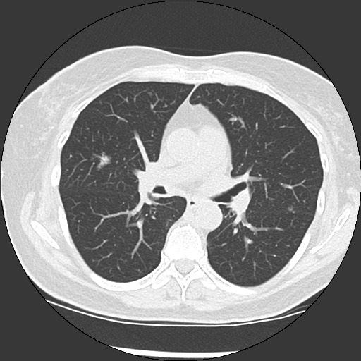Amyloidosis - bronchial and diffuse nodular pulmonary involvement (Radiopaedia 60156-67744 B 27).jpg