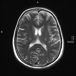 File:Amyotrophic lateral sclerosis (Radiopaedia 70821-81017 Axial T2 15).jpg