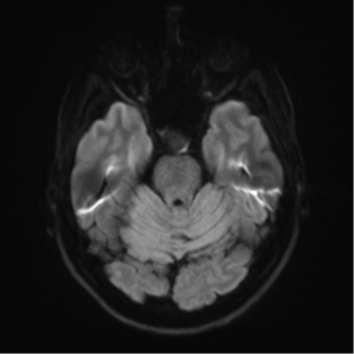 File:Anaplastic astrocytoma - thalamic glioma (Radiopaedia 59709-67115 Axial DWI 46).png