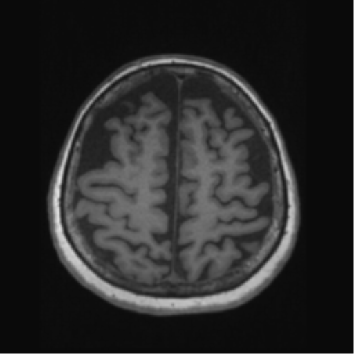 Anaplastic astrocytoma IDH wild-type (pseudoprogression) (Radiopaedia 42209-45276 Axial T1 115).png