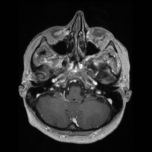 File:Anaplastic astrocytoma IDH wild-type (pseudoprogression) (Radiopaedia 42209-45276 Axial T1 C+ 36).png