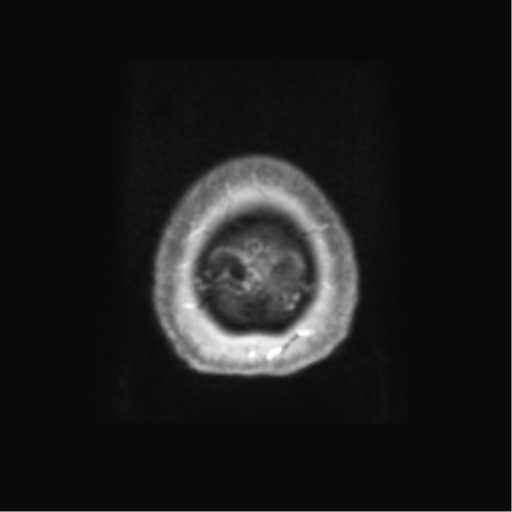 Anaplastic astrocytoma IDH wild-type (pseudoprogression) (Radiopaedia 42209-45279 Axial T1 C+ 140).png