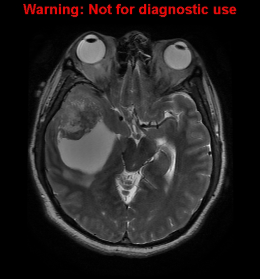 File:Anaplastic ganglioglioma (Radiopaedia 44921-48831 Axial T2 13).jpg