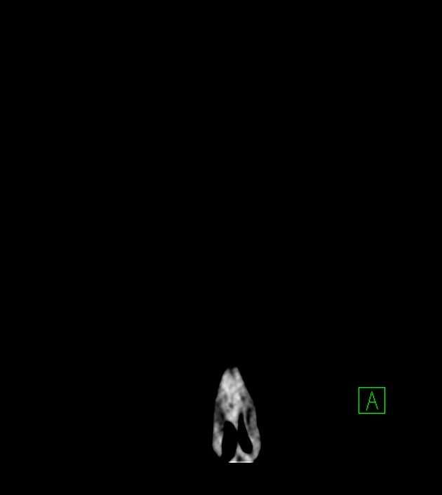 Anaplastic oligodendroglioma (Radiopaedia 79571-92753 Coronal non-contrast 4).jpg