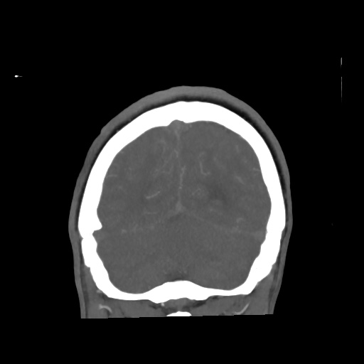 Aneursym related subarachnoid hemorrhage with hydrocephalus (Radiopaedia 45105-49084 B 68).jpg
