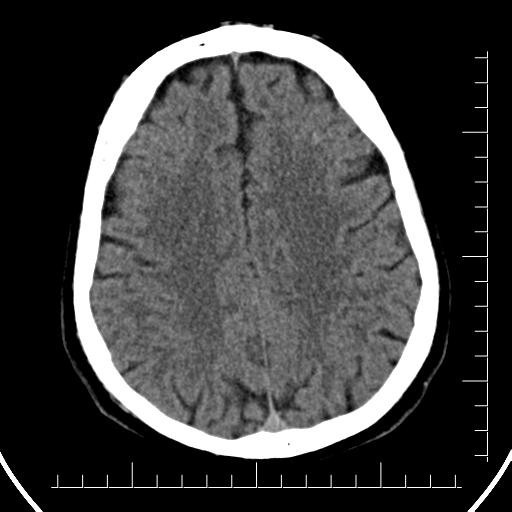 File:Aneurysm of posterior communicating artery (Radiopaedia 20188-20162 Axial non-contrast 34).jpg