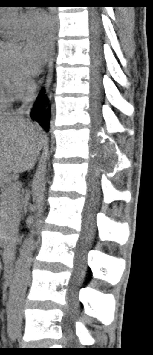 Aneurysmal bone cyst T11 (Radiopaedia 29294-29721 E 41).jpg