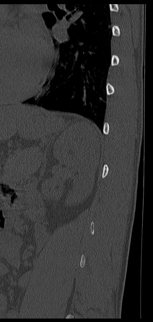 Aneurysmal bone cyst T11 (Radiopaedia 29294-29721 Sagittal bone window 10).jpg