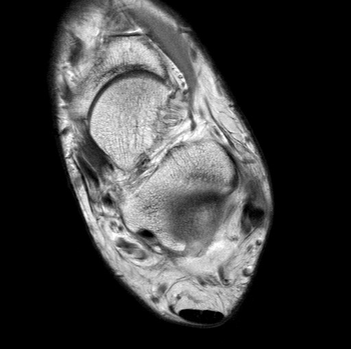 File:Aneurysmal bone cyst of the calcaneus (Radiopaedia 60669-68420 Axial PD 17).jpg