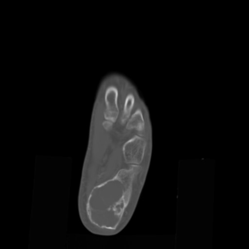 File:Aneurysmal bone cyst of the calcaneus (Radiopaedia 60669-68421 Axial bone window 14).jpg