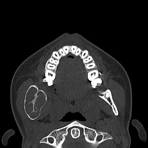 Aneurysmal bone cyst of the mandible (Radiopaedia 43280-46601 Axial bone window 42).jpg