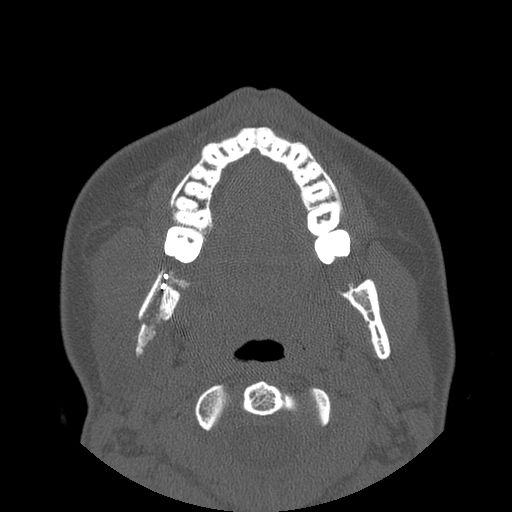 Aneurysmal bone cyst of the mandible (Radiopaedia 43280-46823 Axial bone window 80).jpg