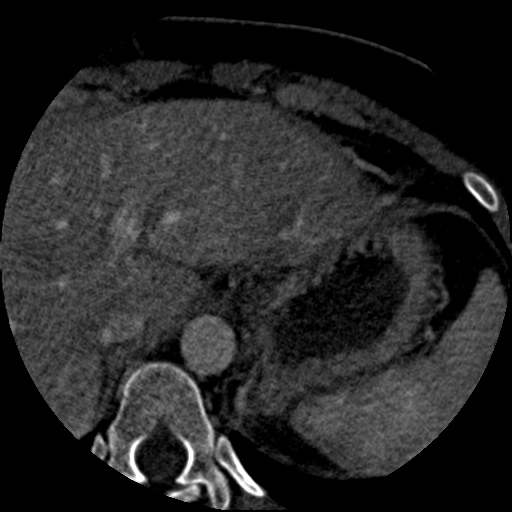 File:Anomalous left coronary artery from the pulmonary artery (ALCAPA) (Radiopaedia 40884-43586 A 92).jpg