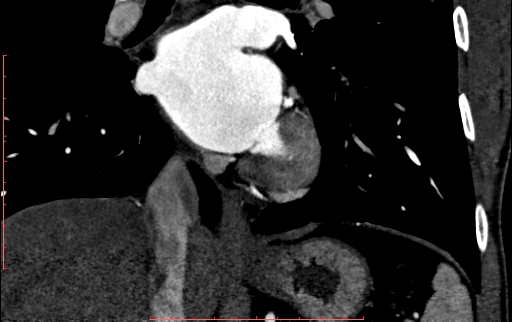 Anomalous left coronary artery from the pulmonary artery (ALCAPA) (Radiopaedia 70148-80181 B 209).jpg