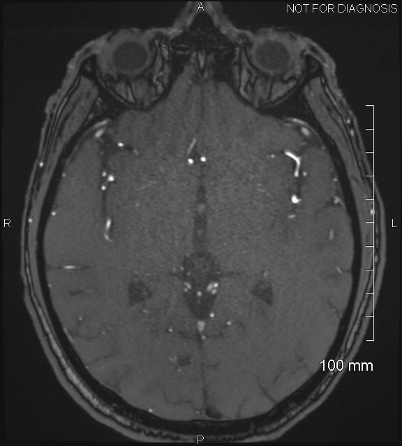 Anterior cerebral artery aneurysm (Radiopaedia 80683-94127 Axial MRA 117).jpg
