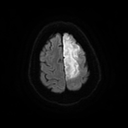 Anterior cerebral artery infarction (Radiopaedia 46794-51323 Axial DWI 24).jpg