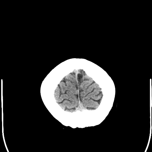 File:Anterior cerebral artery territory infarct (Radiopaedia 39327-41581 Axial non-contrast 27).png