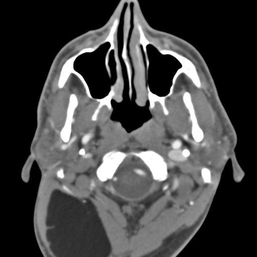 File:Anterior cerebral artery territory infarct (Radiopaedia 39327-41581 B 53).png