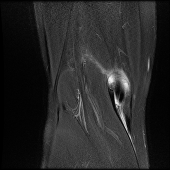 File:Anterior cruciate ligament graft tear and bucket-handle tear of medial meniscus (Radiopaedia 75867-87255 Coronal PD fat sat 24).jpg