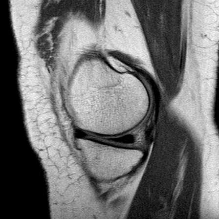 File:Anterior cruciate ligament mucoid degeneration (Radiopaedia 60853-68633 Sagittal PD 11).jpg