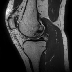 Anterior cruciate ligament rupture and posteromedial corner injury (Radiopaedia 67338-76723 Sagittal PD 68).jpg