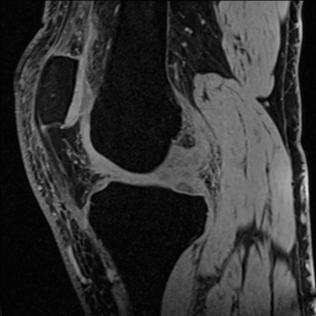 Anterior cruciate ligament tear - ramp lesion (Radiopaedia 71883-82322 Sagittal T1 vibe 85).jpg