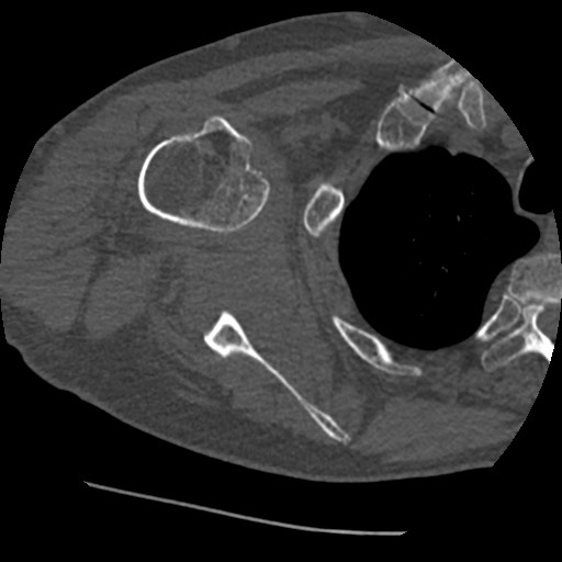 Anterior glenohumeral dislocation with Hill-Sachs lesion (Radiopaedia 62877-71249 Axial bone window 50).jpg