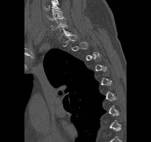 Anterior glenohumeral dislocation with Hill-Sachs lesion (Radiopaedia 62877-71249 Sagittal bone window 75).jpg