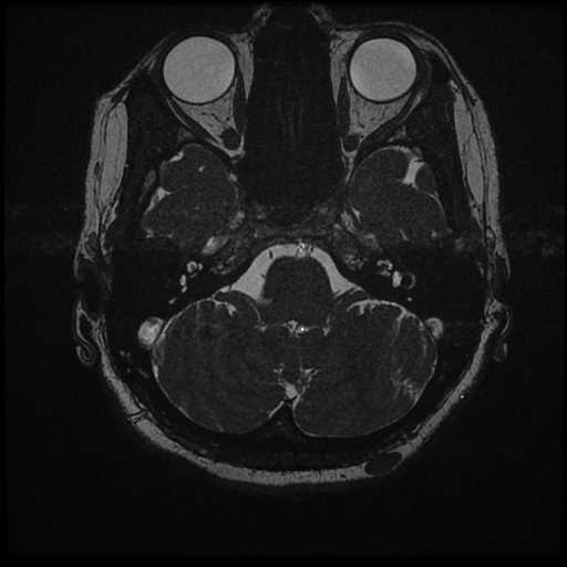 Anterior inferior cerebellar artery vascular loop - type II (Radiopaedia 70991-81209 Axial 3D FIESTA 47).jpg