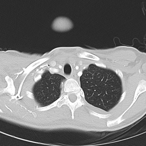 Anterior mediastinal lymphoma (Radiopaedia 29556-30061 Axial lung window 8).jpg