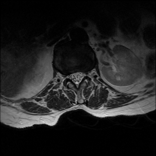 File:Anterior spinal artery syndrome (Radiopaedia 46335-50750 Axial T2 28).png