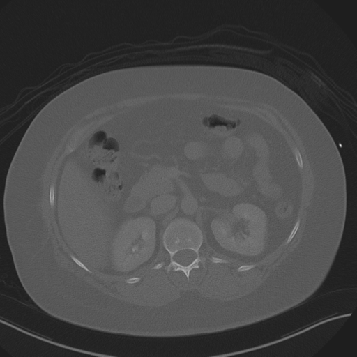 Anterior superior iliac spine avulsion fracture (Radiopaedia 44541-48244 Axial bone window 35).png