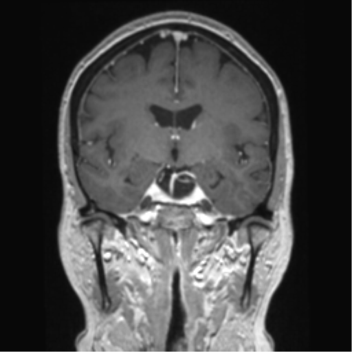Anterior temporal pole cysts (Radiopaedia 46629-51102 Coronal T1 C+ 94).png