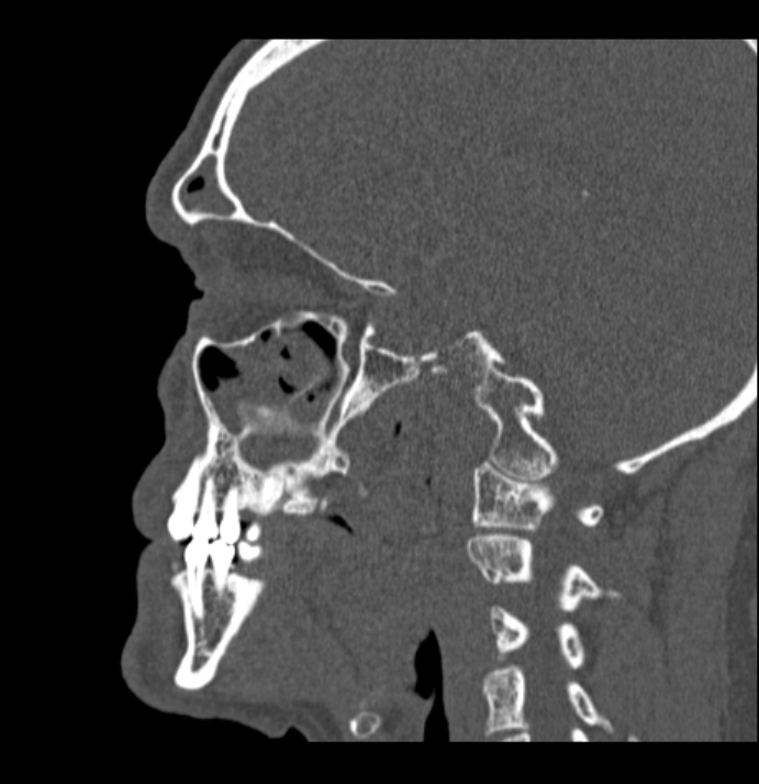 Antrochoanal polyp (Radiopaedia 79011-92169 Sagittal bone window 12).jpg
