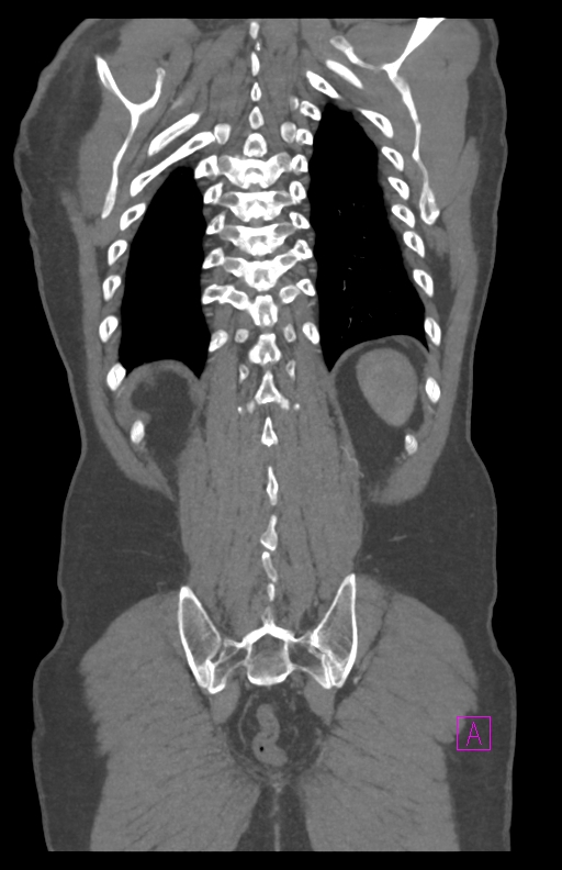 Aortectomy and axillary-bifemoral bypass (Radiopaedia 28303-28545 C 77).jpg