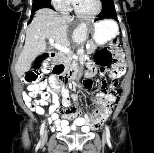 File:Aortic aneurysm and Lemmel syndrome (Radiopaedia 86499-102554 C 21).jpg