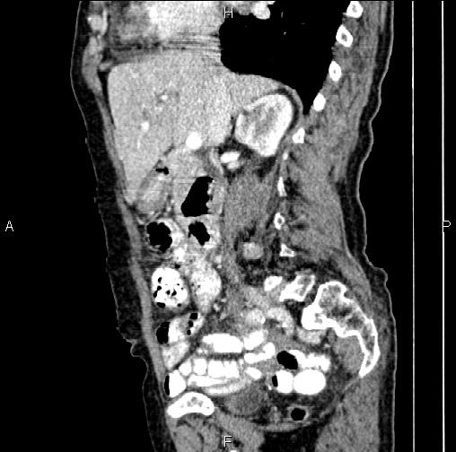 File:Aortic aneurysm and Lemmel syndrome (Radiopaedia 86499-102554 D 35).jpg