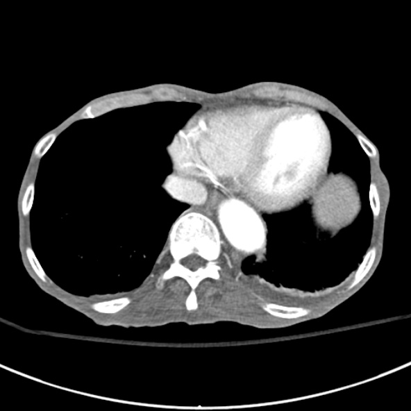 File:Aortic aneurysm with spinal destruction (Radiopaedia 42301-45410 A 5).jpg